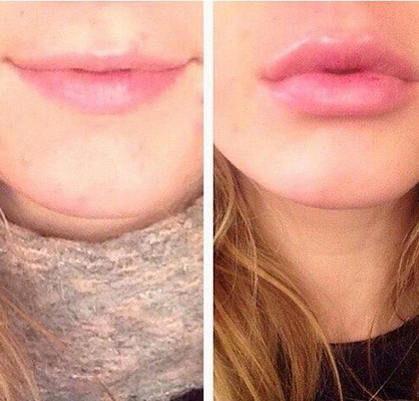 Fullips присоска. Фото ДО и ПОСЛЕ. Видео. Тренажер для увеличения губ. Как сделать губы больше без уколов и гиалуронки. Fullips присоска. Фото ДО и ПОСЛЕ. Видео. Тренажер для увеличения губ. Как сделать губы больше без уколов и гиалуронки.