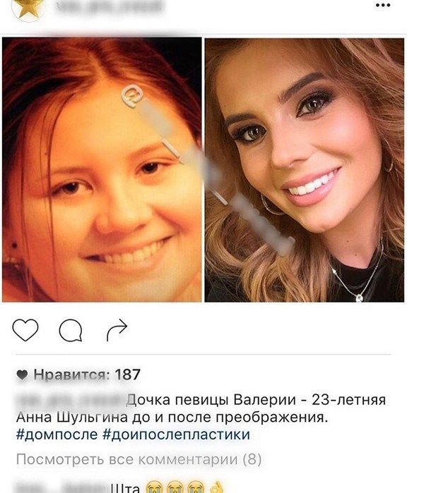 Анна Шульгина показала фото до пластики Анна Шульгина показала фото до пластики